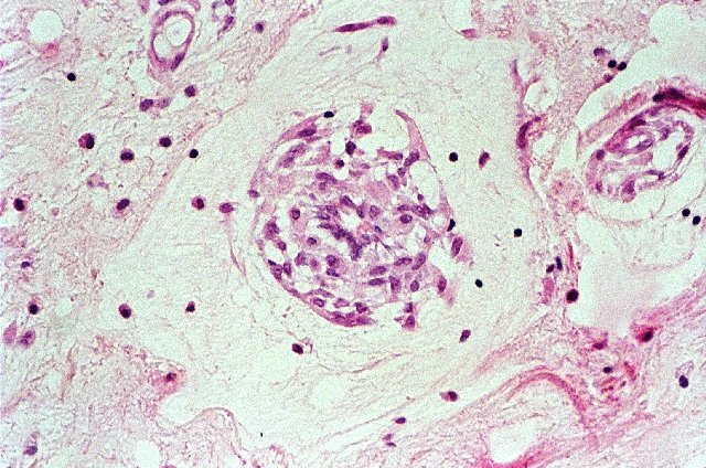 Figura 5. - Canal vascular formado por clulas mixoma estrelladas y rodeadas por halo acelular. Hematoxilina & eosina, 40x.